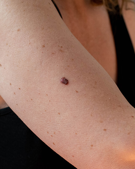Hautkrebsscreening, California Skin, Ihre Experten für Faltenbehandlungen in Landshut